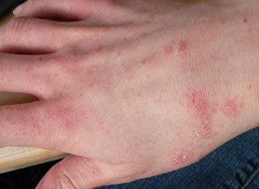 Allergy Treatment