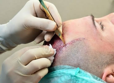 Laser Treatment
