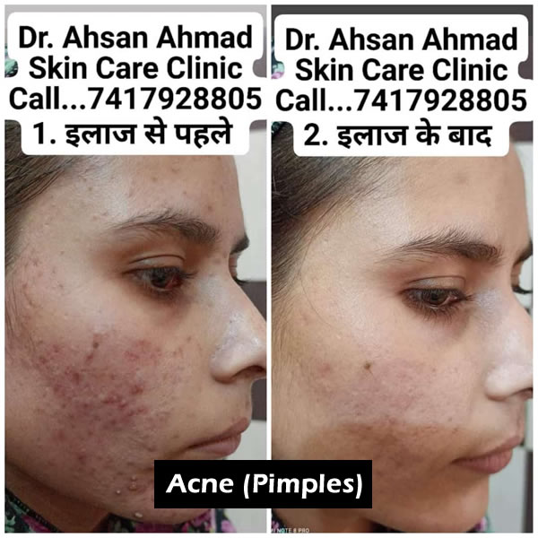Before After