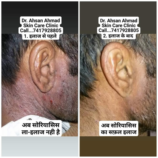 Before After