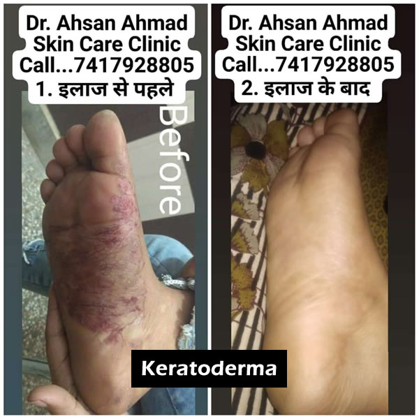 Before After