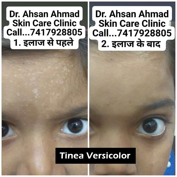 Before After